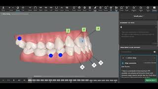 Class III Invisalign [upl. by Wittie]