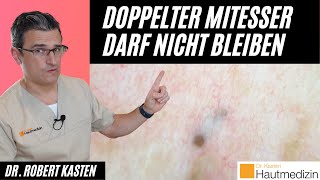 Doppelt endender Mitesser Darf nicht bleiben  Dr Kasten Hautmedizin in Mainz mitesser [upl. by Yenattirb]