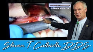 Endodontics amp Apicoectomy on a Lateral Incisor  Dental Minute with Steven T Cutbirth DDS [upl. by Collins645]