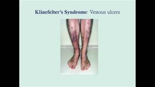 Klinefelters Syndrome  CRASH Medical Review Series [upl. by Gawen]