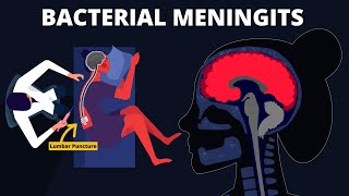 Bacterial Meningitis  Symptoms Diagnosis Treatments amp Pathology [upl. by Engdahl702]