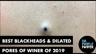 Best Of Blackheads and Dilated Pores of Winer for 2019 [upl. by Sergeant]