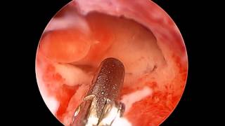 Hysteroscopic Polypectomy of a Sessile Endometrial Polyp [upl. by Waterer]