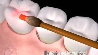 Denver CO Dentist Shares Video Animation of New Laser Periodontal Disease Treatment [upl. by Hilten526]