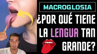 ¿Por qué tienen la LENGUA tan GRANDE y LARGA  MACROGLOSIA [upl. by Joselyn403]