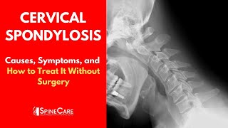 CERVICAL SPONDYLOSIS Causes Symptoms and Treatment NO SURGERY [upl. by Ggerk]