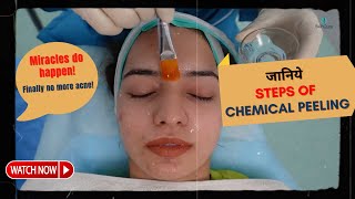 Step by Step Chemical Peeling treatment for Acne  Peeling treatments for Peel  SkinQure Dr Jangid [upl. by Eudora]