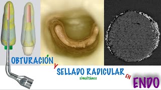 Curso Obturación Apical y Sellado Radicular simultáneo en Endodoncia UNPL Argentina [upl. by Ide510]