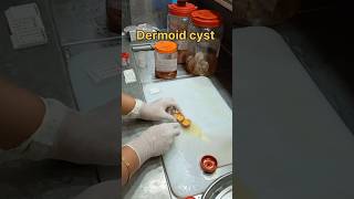 Dermoid cyst scalp dermoidcyst டெர்மாய்டிசிஸ்ட் cyst pathology tissuefixation [upl. by Rafaelof]