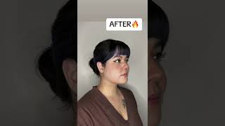 INSANE Chin Lipo RESULTS😱 chinlipo chinliposuction beforeandafter doublechin doublechinremoval [upl. by Halvaard689]