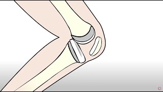 Knee Replacement vs Regenexx Orthopedic Regenerative Treatment [upl. by Ferdie547]