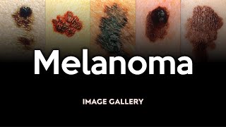 Melanoma Image Gallery [upl. by Florry]