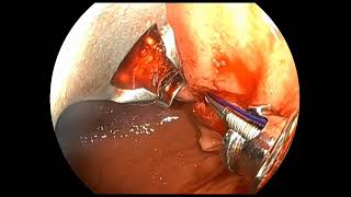 Endoscopic sleeve gastroplasty using mixedtooth grasping forceps as alternative to the tissue helix [upl. by Annemarie347]