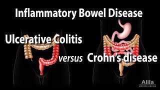 Ulcerative Colitis versus Crohns Disease Animation [upl. by Merrel]