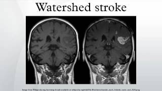 Watershed stroke [upl. by Alaehcim]