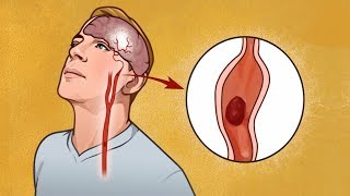 Don’t Ignore These Warning Signs Before a Stroke — They Can Save a Life [upl. by Nnad940]