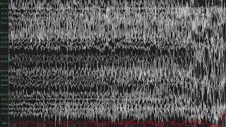 Interictal Discharges amp GTC Seizure [upl. by Landbert]