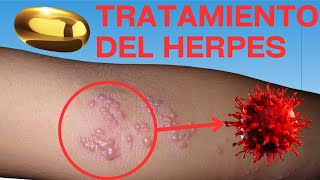 Tratamiento del herpes [upl. by Nedla]