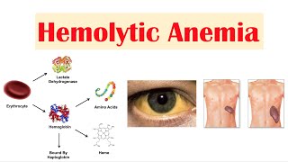 Hemolytic Anemia [upl. by Cinda]