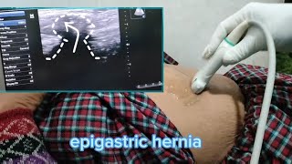 epigastric hernia usg [upl. by Garratt]