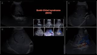 BuddChiari syndrome BCS [upl. by Torre203]