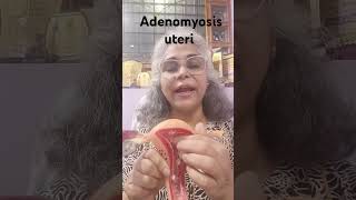 Adenomyosis of uterus health इनफॉर्मेशन [upl. by Lusty]