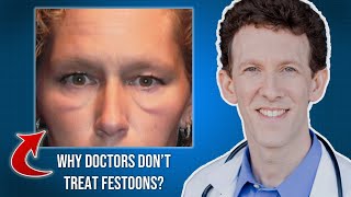 Why Many Doctors Dont Treat Festoons [upl. by Betthel]