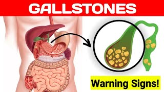 Gallstones Warning Signs amp Symptoms  Cholelithiasis  Health Flavour [upl. by Aisemaj]