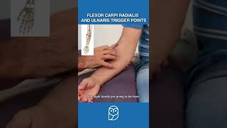 Is Your Wrist Pain Caused By Trigger Points In the Forearm Flexors [upl. by Wareing]