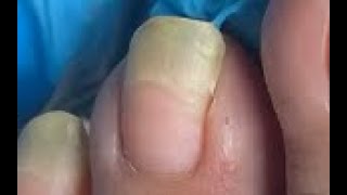 Longest toenail of the month [upl. by Ennaeirb23]