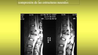 NeurorgsnetFractura aplastamiento traumatica L1 Pablo Hernandez [upl. by Gatias467]