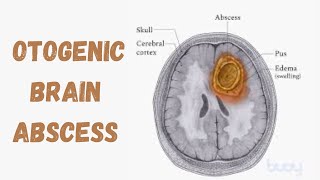 Otogenic Brain Abscess  Intracranial Complication Of Suppurative Otitis Media [upl. by Kimball269]