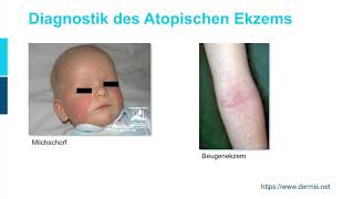 Dermatologie ─ Atopische Dermatitis Teil 12 [upl. by Luapsemaj]