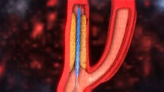 Carotid Artery Stenting video [upl. by Ecneralc575]