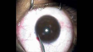 Verisyse Lens Phakic Intraocular IOL Procedure NNJEI [upl. by Uy744]