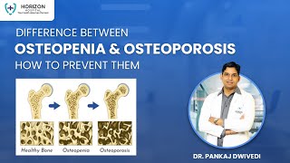 Difference between Osteopenia and Osteoporosis by Orthopedic Dr Pankaj Dwivedi [upl. by Ylloh444]