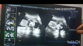 Anencephaly l The fetal abnormality I Neurogenic abnormal fetus condition [upl. by Neyut]