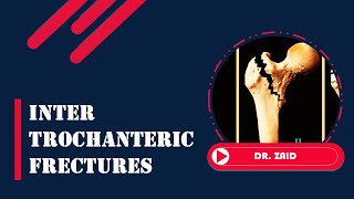 Intertrochanteric fractures  Dr Zaid  Lecture 3 [upl. by Akemehc]