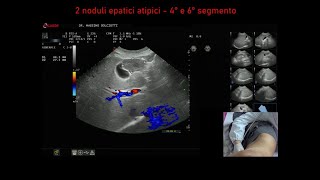 2 noduli epatici atipici al 4° e al 6° segmento [upl. by Rafaellle656]