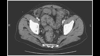 Thrumbprints bei ischämischer Colitis [upl. by Anerec]