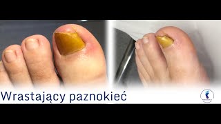 Po usuwaniu wrastającego paznokcia  wizyta kontrolna  After ingrown nail removal  control visit [upl. by Zilef177]