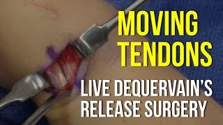 Moving Tendons In A Live Surgery  DeQuervain’s Release [upl. by Haddad]