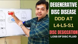 Degenerative Disc Disease DDD L4 L5 L5 S1Disc Desiccation Disc Degeneration Disease Treatment [upl. by Nilatak]