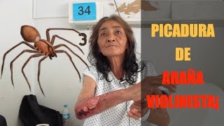 Sra Violeta Chiñas  Paciente con Picadura de Araña Violinista en Cuautla Morelos [upl. by Deina]