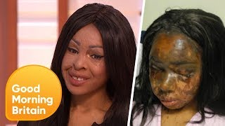 Recovering From an Acid Attack  5 Years on  Good Morning Britain [upl. by Huston]