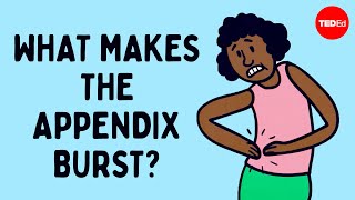 What does appendix pain feel like  David R Flum [upl. by Vitia]