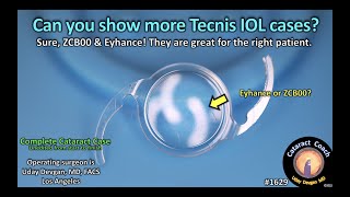 CataractCoach 1629 can you show more tecnis IOL cases Eyhance ZCBOO [upl. by Eednim754]