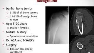 Radiofrequency Ablation of Osteoid Osteoma with Use of Intraoperative Three Dimensional Imaging [upl. by Jewel]