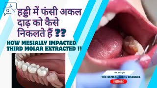 हड्डी में फांसी अकल दाढ़ को कैसे निकालते हैं  HOW MESIALLY IMPACTED THIRD MOLAR IS EXTRACTED [upl. by Juliet136]