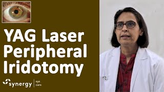 Laser Iridotomy for Glaucoma  Yag Laser Pi Peripheral Iridotomy [upl. by Roderigo]